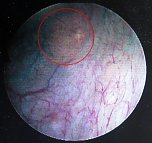 Hier ist nur ein Karzinom erkennbar (Foto: S&uuml;dharz Klinikum Nordhausen)