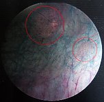 Mit neuer Technologie wird ein weiteres Karzinom erkennbar (Foto: S&uuml;dharz Klinikum Nordhausen)