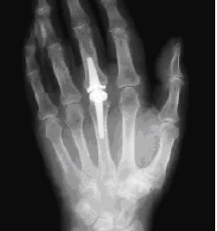 R&ouml;ntgenaufnahme (Foto: Klinik Bleicherode)