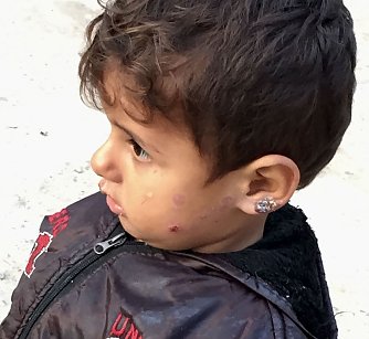 Kinder mit entz&uuml;ndeten und vernarbten Beinen und Gesichtern (Foto: Sara M&uuml;ller)