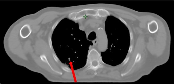 Der Turmor nach der Bestrahlung, nur noch eine Narbe (Foto: SHK)