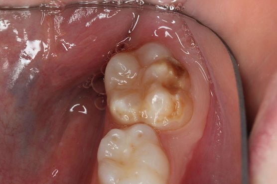 Kreidez&auml;hne (Foto: Dr. Norbert Kr&auml;mer)