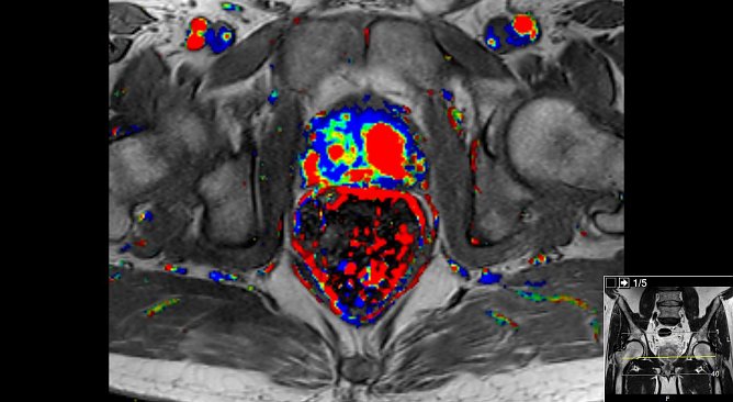 Prostata-Karzinom (Foto: S&uuml;dharz Klinikum)