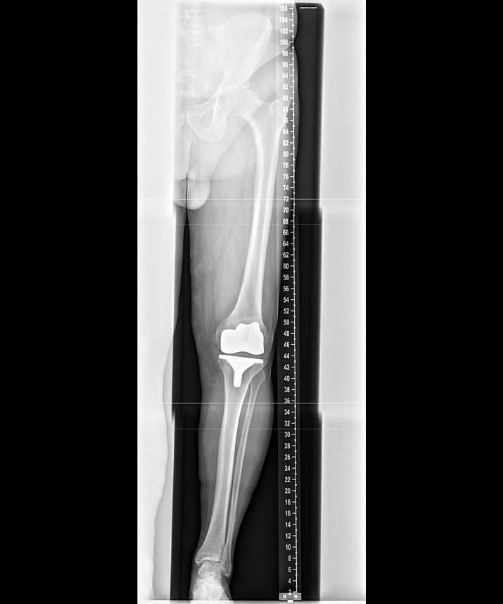 Ganzbeinaufnahme mit dem direkt-digitalen Stitching